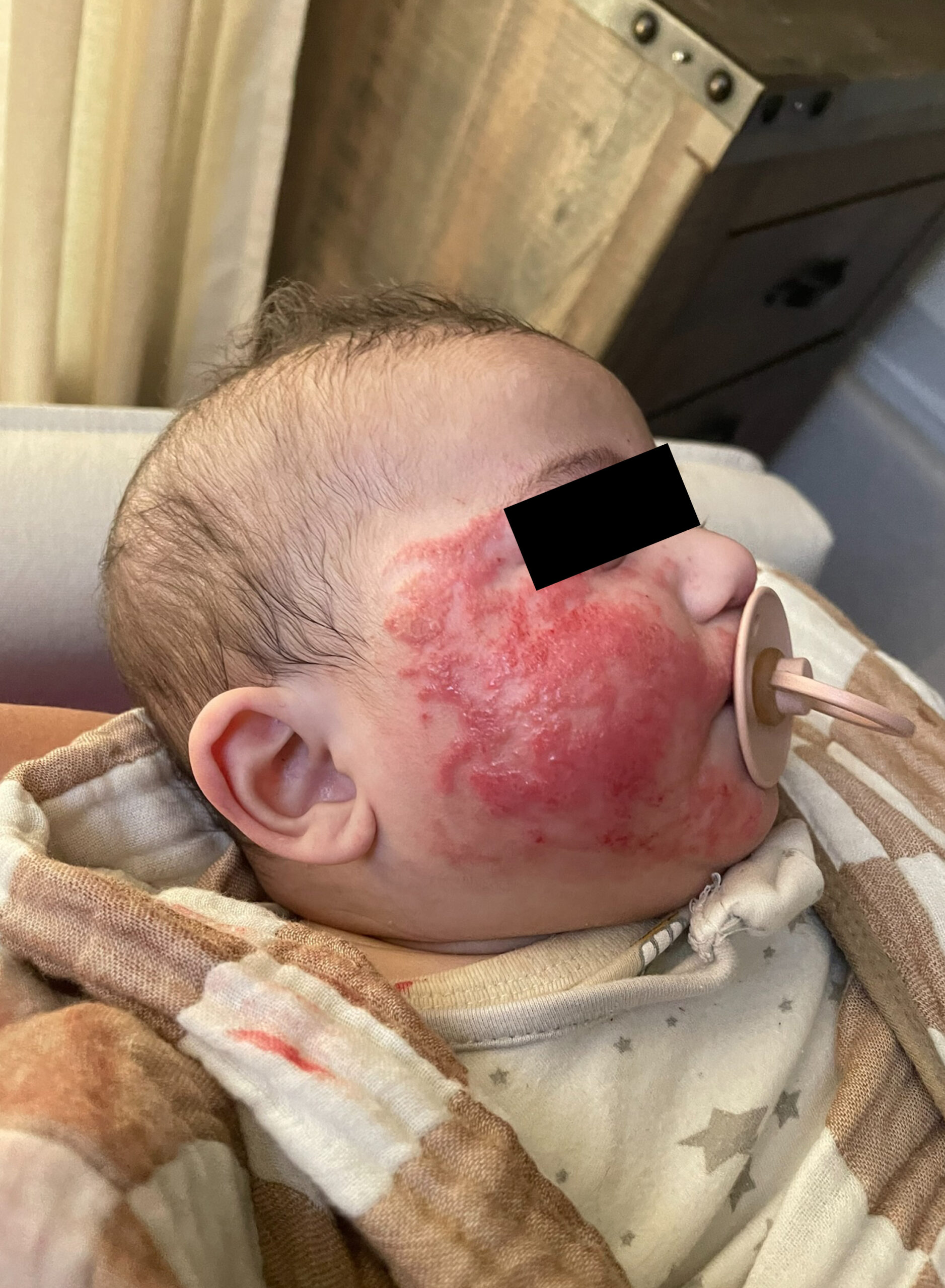 Infant with widespread facial eczema and inflammation at 7 months — eyes redacted for privacy