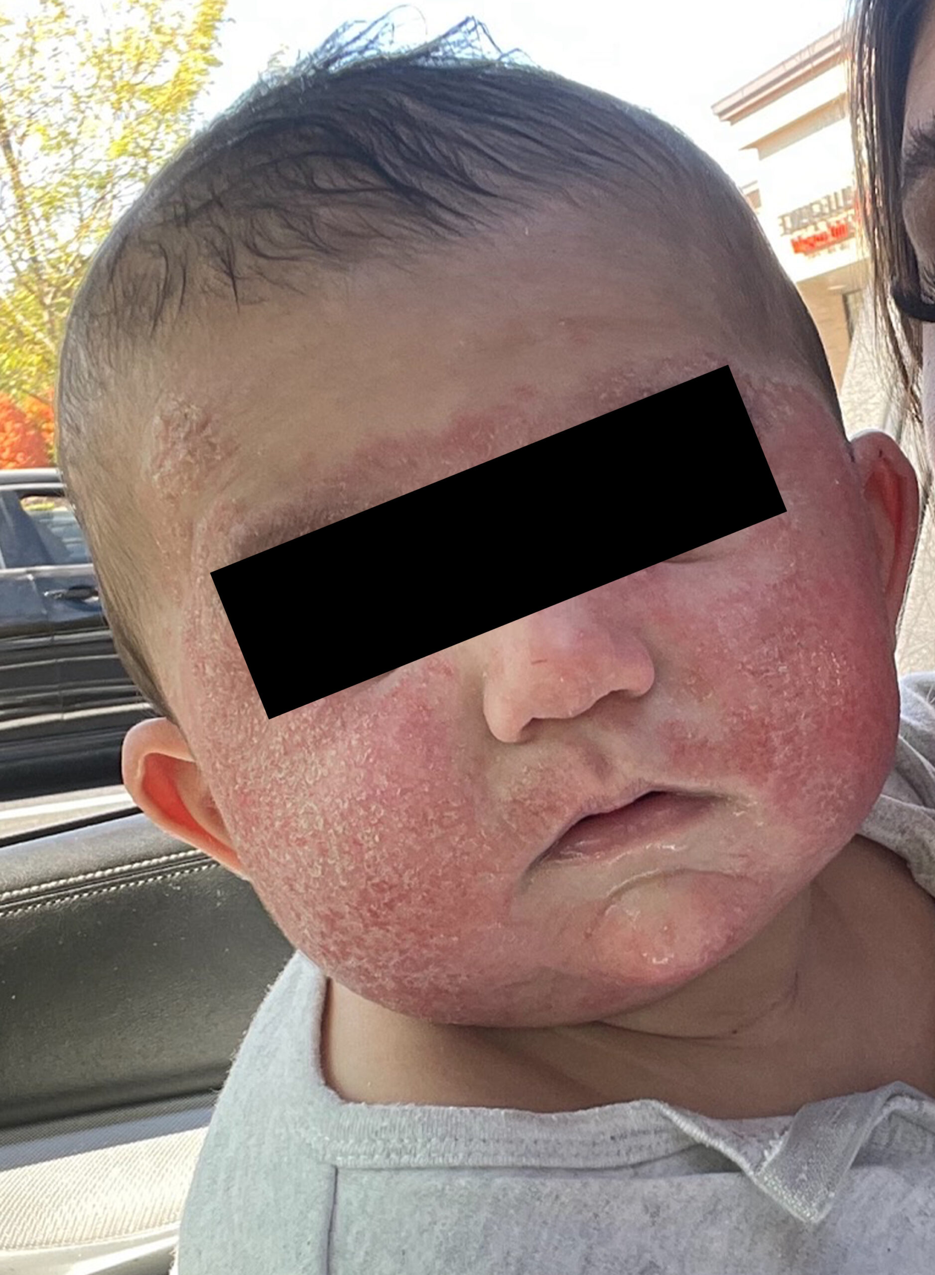Infant with severe facial eczema before food sensitivity testing — eyes redacted for privacy